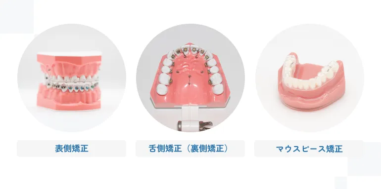 他の矯正法（舌側矯正（裏側矯正）・マウスピース矯正）との違い