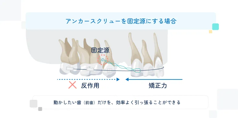 歯科矯正用アンカースクリューを併用