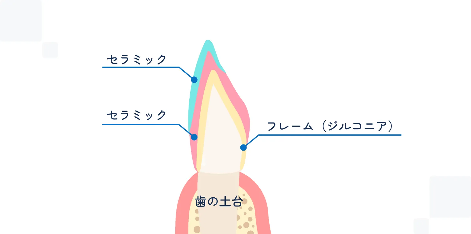 レイヤリングジルコニア