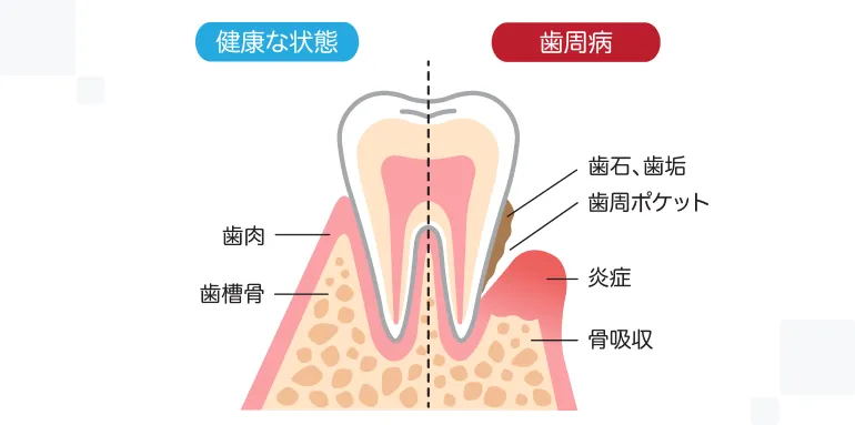 歯を失う原因の１位「歯周病」とは