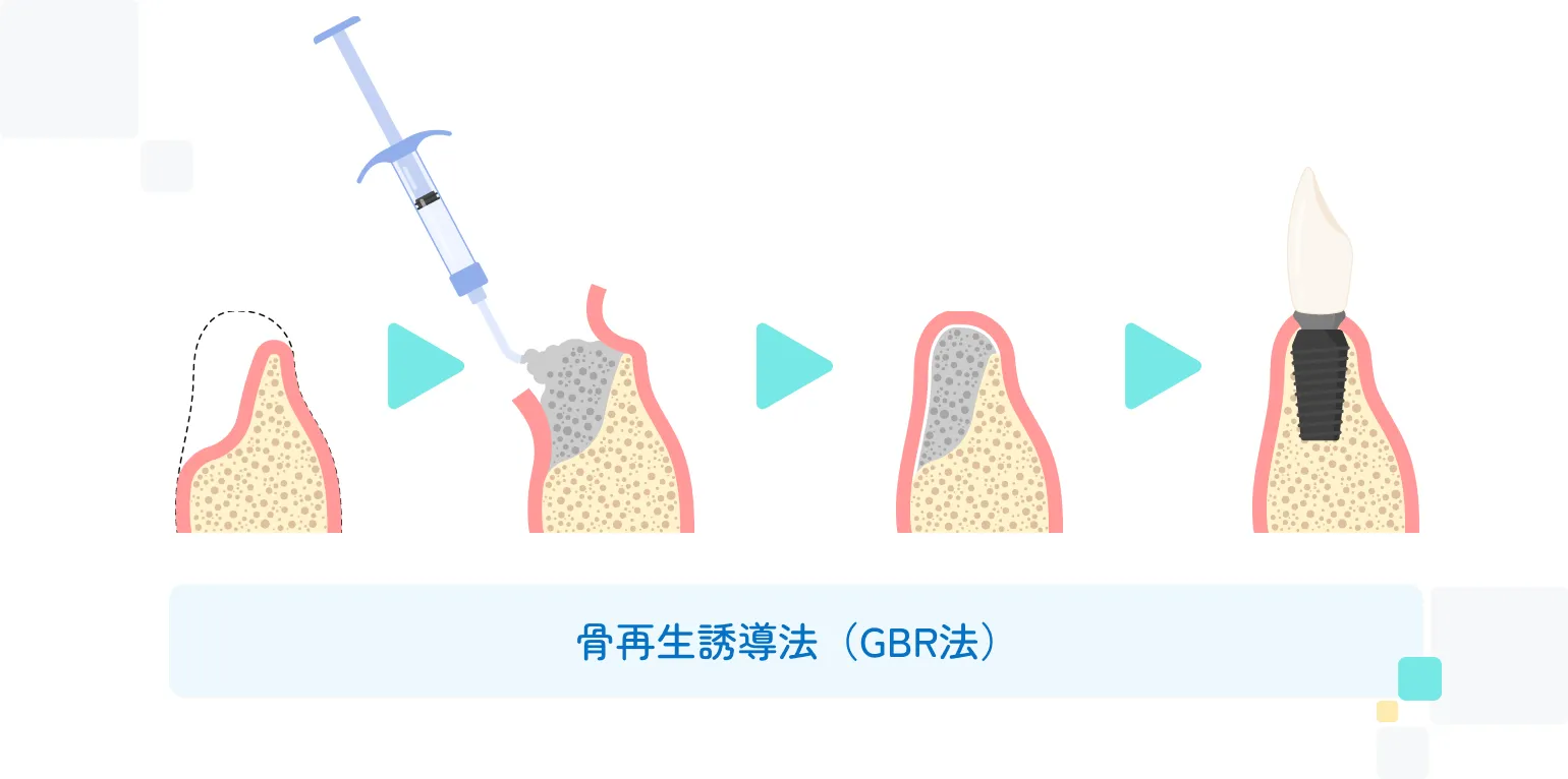 骨の量が足りない場合の骨造成にも対応