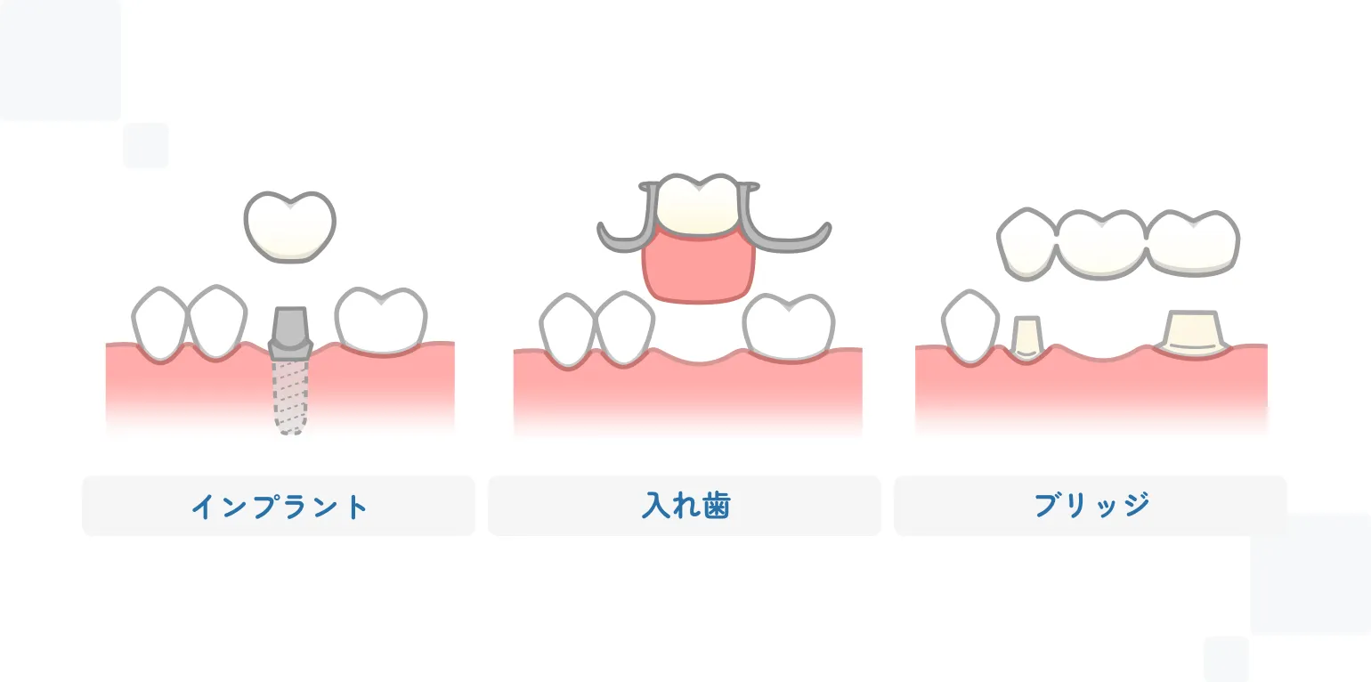 他の治療法（入れ歯・ブリッジ）との違い