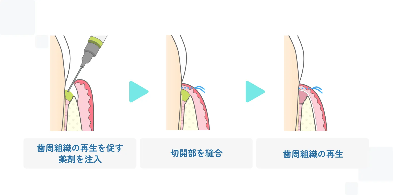 歯周組織再生療法